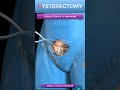 abdominal hysterectomy procedure short view shorts