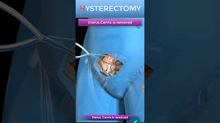 Abdominal Hysterectomy Procedure Short view #shorts