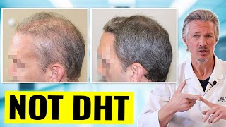 INFLAMMATORY HAIR LOSS 90 DAY RESULTS! SEE WHAT CAN HAPPEN WHEN YOU TREAT THE CA