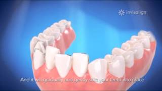 จัดฟัน invisalign จัดฟันแบบใส ถอดได้ไม่เห็นเครื่องมือที่ BIDC