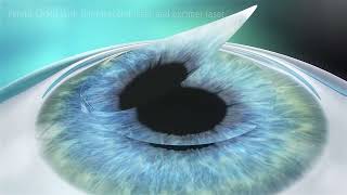 TreatmentAnimationFemto LASIK EN 34 160 0045II