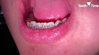 Braces checkups - 11 months progress - coil spring off - Tooth Time Family Dentistry New Braunfels