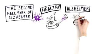 Alzheimer's Disease: The Basics | Being Patient
