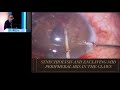 aioc2019 gp098 topic 2 glauco claw – a device for chronic closed angle glaucoma dr kiranjit sin