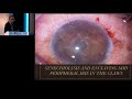 aioc2019 gp098 topic 2 glauco claw – a device for chronic closed angle glaucoma dr kiranjit sin