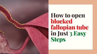 How to open blocked fallopian tube in Just 3 Easy Steps (And Get Pregnant Naturally)