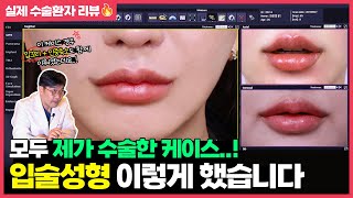 저는 입술 성형 이렇게 합니다! 입술 성형과 인중 성형👄 / 수술 후 역대급 변화 어떻게 변화될까요?!