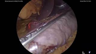 Titan SGS Laparoscopic Sleeve Gastrectomy, Standard Bariatrics, Jersey Shore, Seth Kipnis, MD