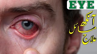 aankhon mein kharish ka ilaj | آنکھوں میں خارش کا علاج | آنکھوں میں پانی آنا | آنکھوں میں جلن