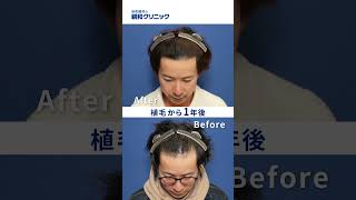 【AGA治療】生え際・前頭部に2000株移植された体験者様へお話を伺いました。【自毛植毛】【植毛】