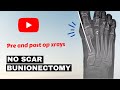 No scar bunionectomy