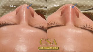 NONSURGICAL CORRECTION OF CROOKED NOSE