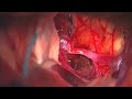 translamina terminalis route via pterional approach to resect retrochiasmatic craniopharyngioma ...