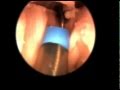 Balloon Sinuplasty for Chronic Sinusitis Treatment (HD)