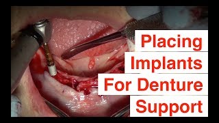 Placing Implants For Denture Support