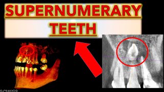 How to Make Sure it is a Supernumerary Tooth? (Extra teeth in mouth, hyperdontia, extra front teeth)