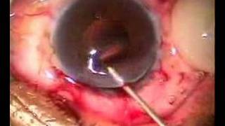 Intracapsular cryo extraction and Artisan Lens implant