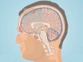 Understanding Subarachnoid Hemorrhage