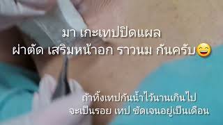 เสริมหน้าอก EP 74 : วิธีเกะพลาสเตอร์ แผล เสริมหน้าอก ทางราวนม วันใหม่คลินิก