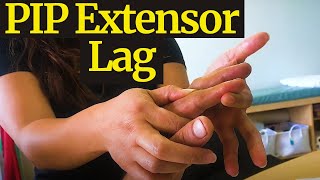 How to Manage PIP Fractures with an Extensor Lag