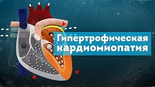 Гипертрофическая кардиомиопатия. Патогенез. Hypertrophic Cardiomyopathy 3D