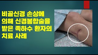 #140 비골신경 손상에 의해 신경봉합술을 받은 족하수 환자의 치료 사례[#116 환자 최근영상추가]