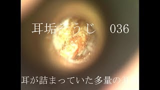 耳垢そうじ/耳が詰まっていた大量の耳垢/036