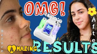 @masbellezaparati  Facial water vacuum Machine. Incredible Instant Results