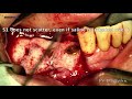 how to prepare s1 putty bovine bone properly for easy ridge augmentation