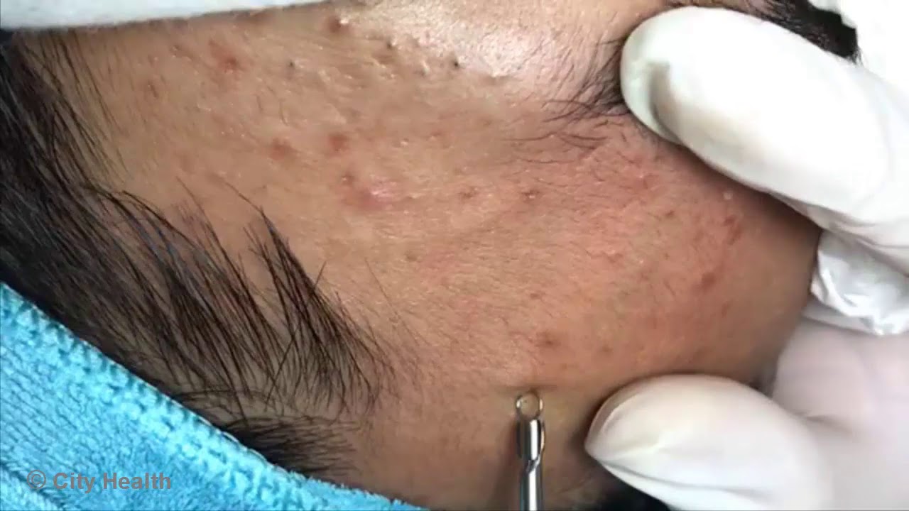 Satisfying Blackhead 2019 - Blackheads Removal - YouTube