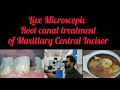 Access opening of Maxillary Central Incisor Step by Step Live Demonstration