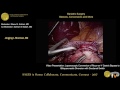 laparoscopic conversion of rygb to bpd ds