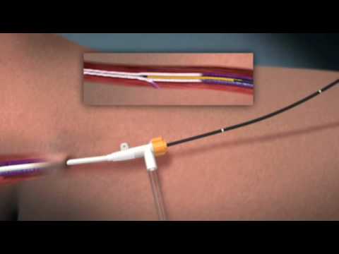 ClosureFast Radiofrequency Catheter Procedure - YouTube