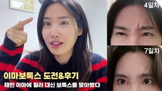 Vlog | 이마 볼륨, 필러 대신 보톡스로 해결✨ | 쌩얼주의) 시술 당일 ~ 2주차 후기 | 이마 보톡스 부작용 | 콤플렉스 해결✌️