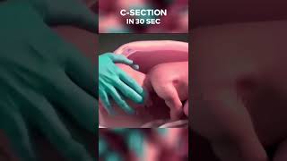 3D सिजेरियन डिलीवरी 30 sec में! A quick look at C-section birth #cesareandelivery #pregnancy #baby