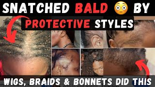 Going BALD From Wigs, Weaves, Braids & Bonnets | Traction Alopecia Warning Signs & Tips