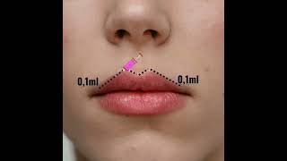 Hướng dẫn kỹ thuật tiêm filler môi #orchard #filler #lipfillers #shorts