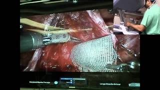 Dr Naveen Kella Applying Amniotic Patch during Prostatectomy  .mp4