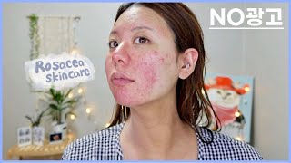 로사세아 주사피부염 확진자가 쓰는 스킨케어 / rosacea skincare JAENA 재나