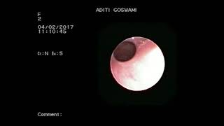 Bilateral choanal atresia: follow up at 2 year