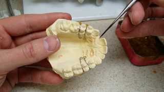 Trimming a Pontic Tooth for an Orthodontic Flipper