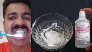 നിങ്ങളുടെ പല്ല് വെളുവെളന്ന് വെളിപ്പിക്കം ||INSTANT TEETH WHITENING WITH HYDROGEN PEROXIDE-  REMEDY