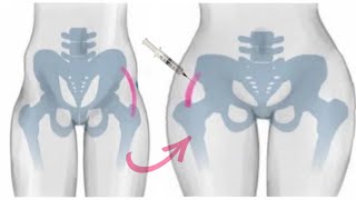 extreme hip expansion — 💉abnormally wide curvy hips (caution)