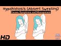 Silent Sweat: Hypohidrosis Unveiled - Causes, Symptoms, and Treatment