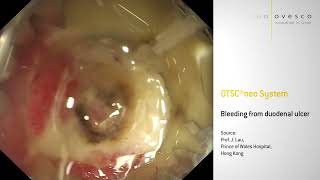 OTSC®neo - bleeding from duodenal ulcer