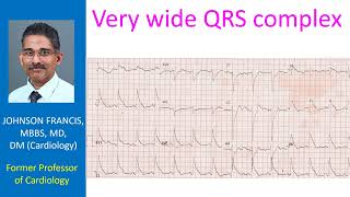 Very wide QRS complex