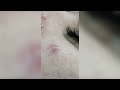 popping huge blackheads and giant pimples best pimple popping videos 170