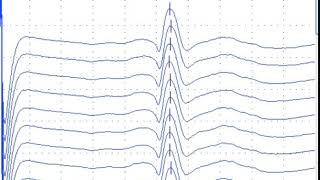 SFEMG - Axon reflex in SFEMG  (Stalberg, Kouyoumdjian, Sanders)