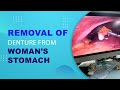 Teeth Removal from Stomach Laparoscopically by Dr. Seraj Ahmed