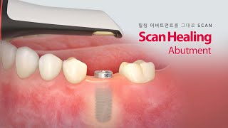 [Scan Healing] Scan Healing Abutment_힐링어버트먼트를 분리하지 않고 임플란트 인상채득이 가능한 Abutment